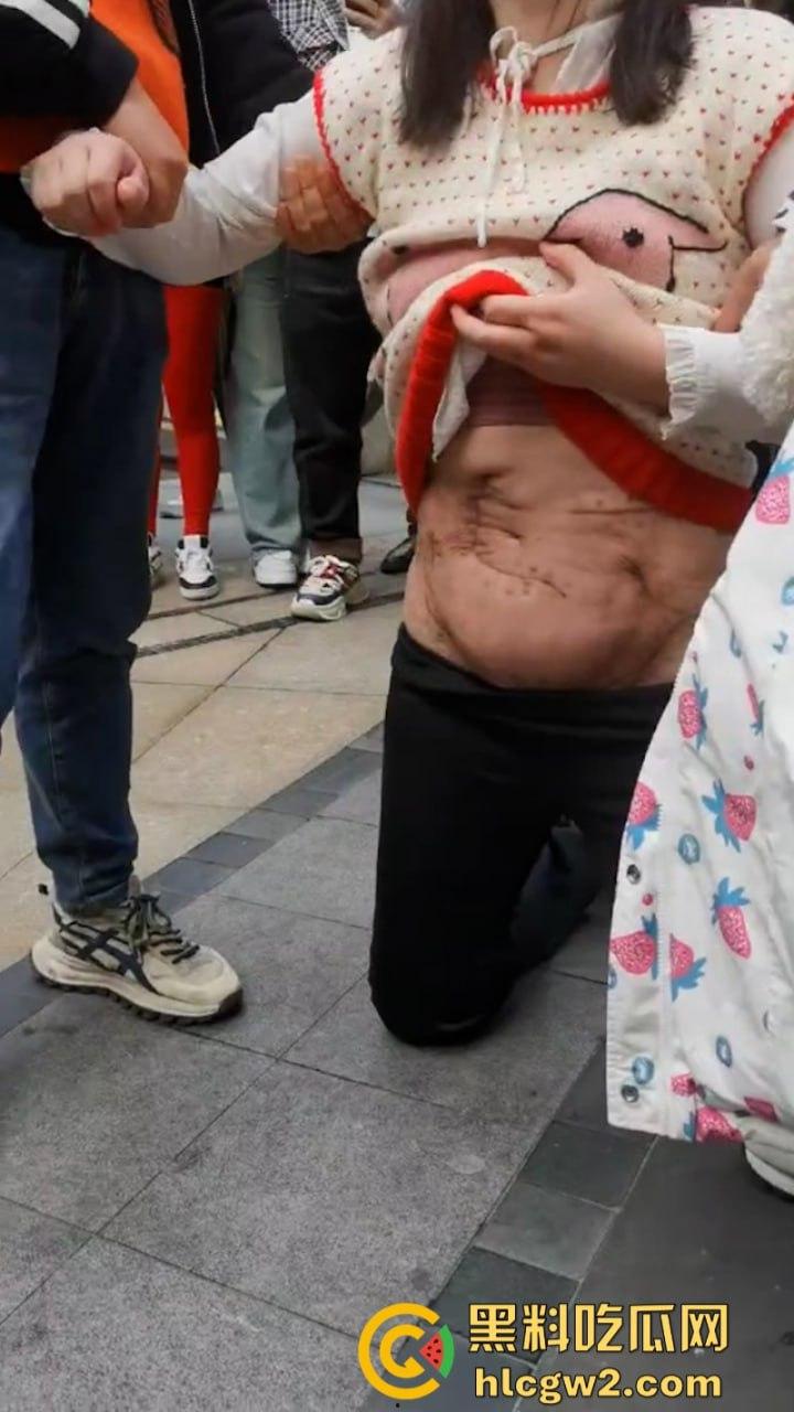 四川泸州胖妹抽脂被戳破大肠差点没命 路边哭喊陈清美容院血债血偿-8